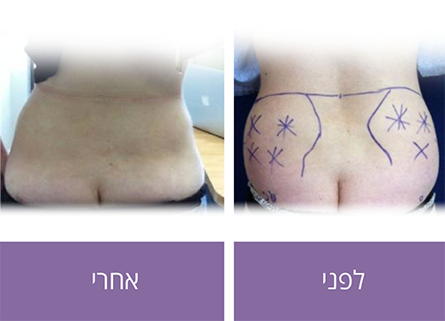 pics-before%d7%9e%d7%95%d7%aa%d7%a0%d7%99%d7%99%d7%9d3