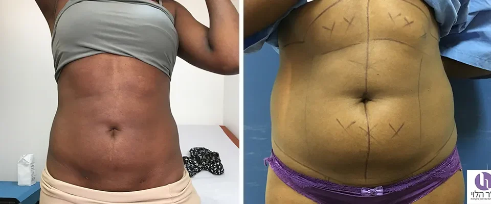 לפני ואחרי שאיבת שומן בטן.
