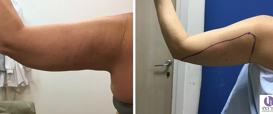 לפני ואחרי שאיבת שומן זרועות