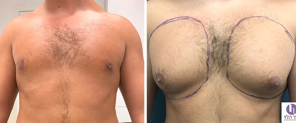 לפני ואחרי שאיבת שומן חזה גברי