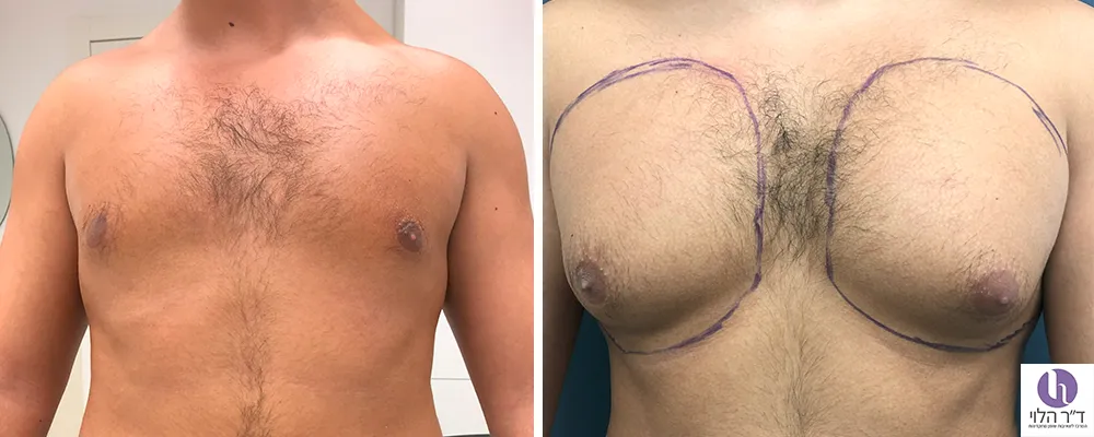 לפני ואחרי שאיבת שומן חזה גברי