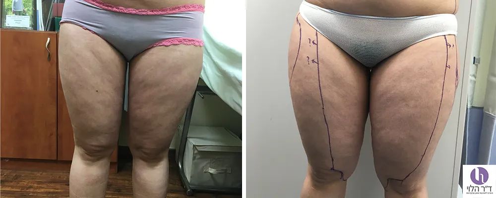 לפני ואחרי שאיבת שומן ירכיים פנימיות