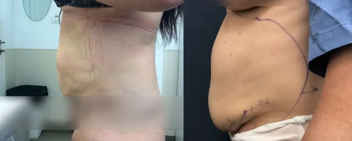 לפני ואחרי שאיבת שומן בבטן